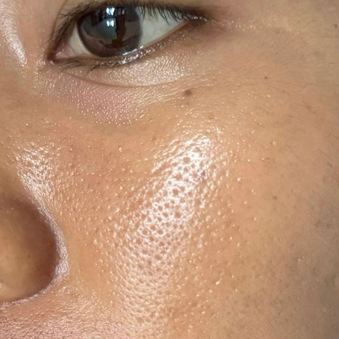 Oily skin