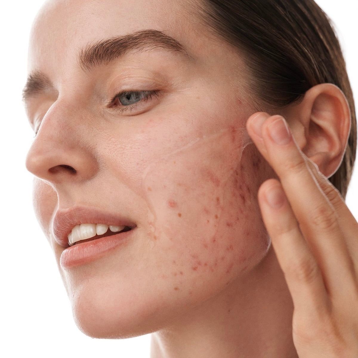 Acne